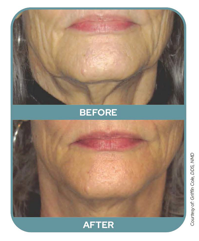 Before After Smoothlase