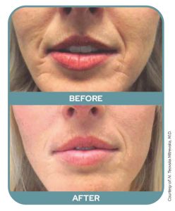Before After Smoothlase