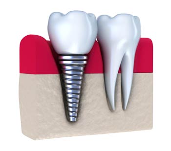 implants1a